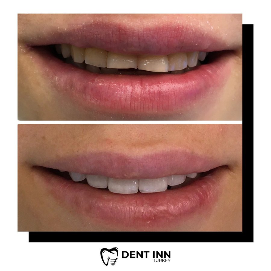 Dent Inn Turkey - Dent Inn Turkey