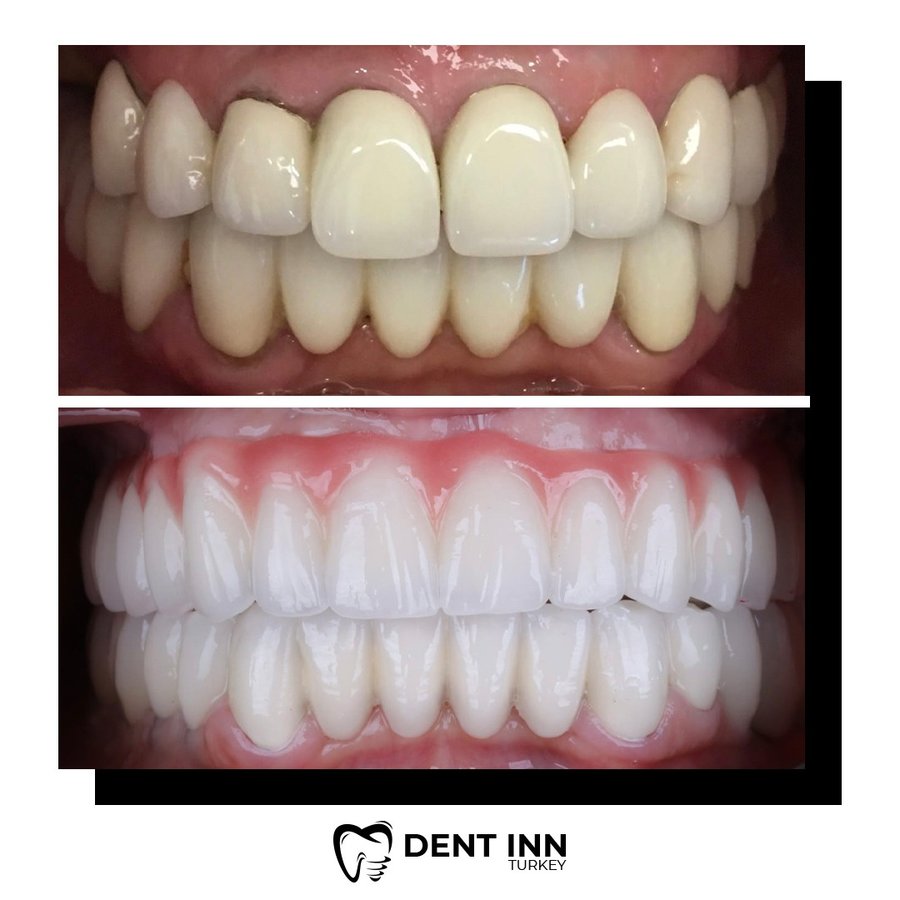 Dent Inn Turkey - Dent Inn Turkey