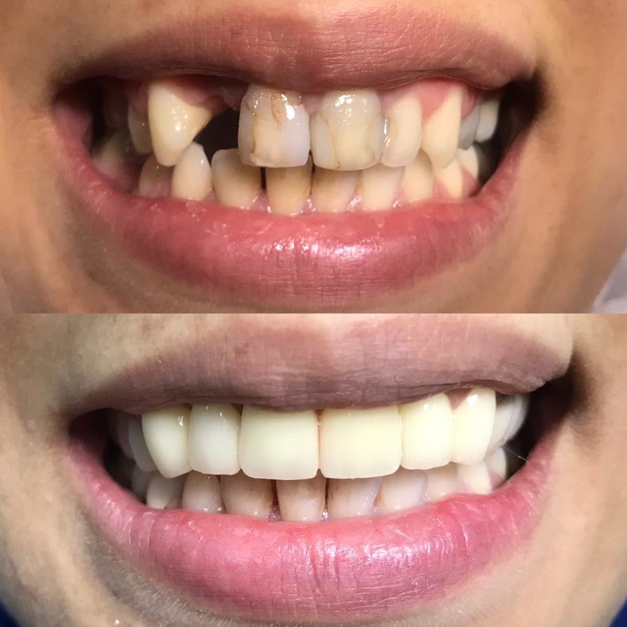 Dent Laracity - Dent Laracity