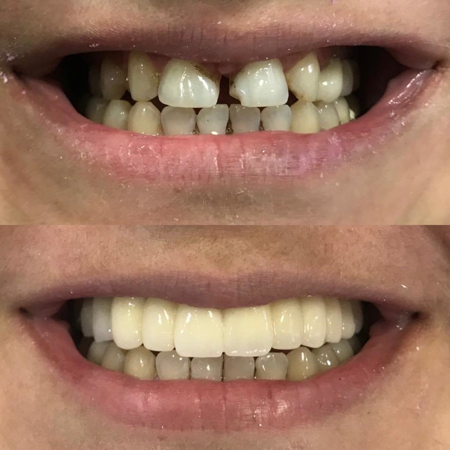 Dent Laracity - Dent Laracity