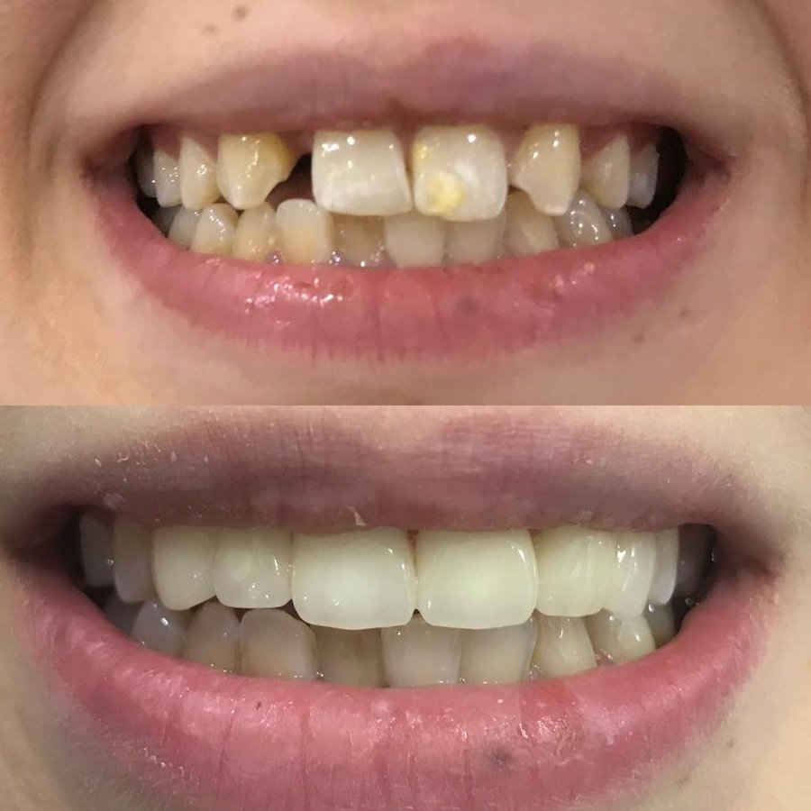 Dent Laracity - Dent Laracity