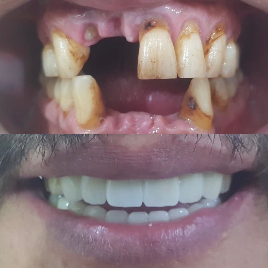 Dent Laracity - Dent Laracity