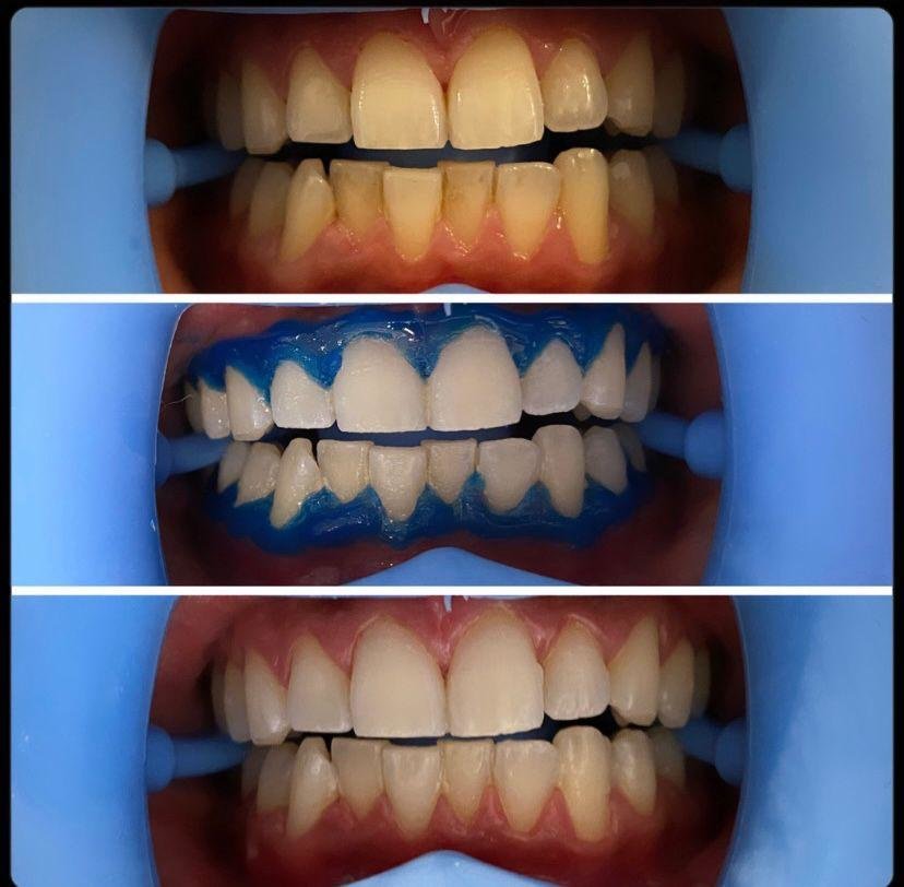 Dent Laracity - Dent Laracity