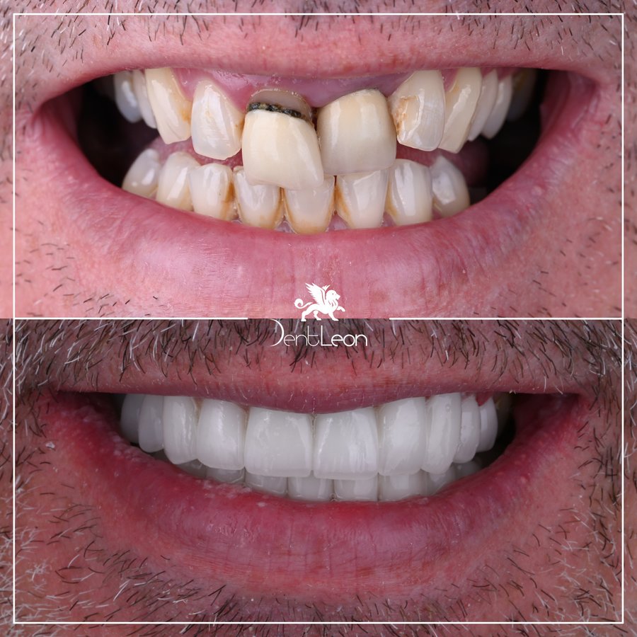 Dent Leon - Dent Leon