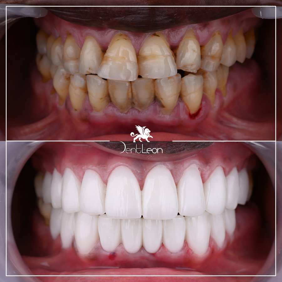 Dent Leon - Dent Leon