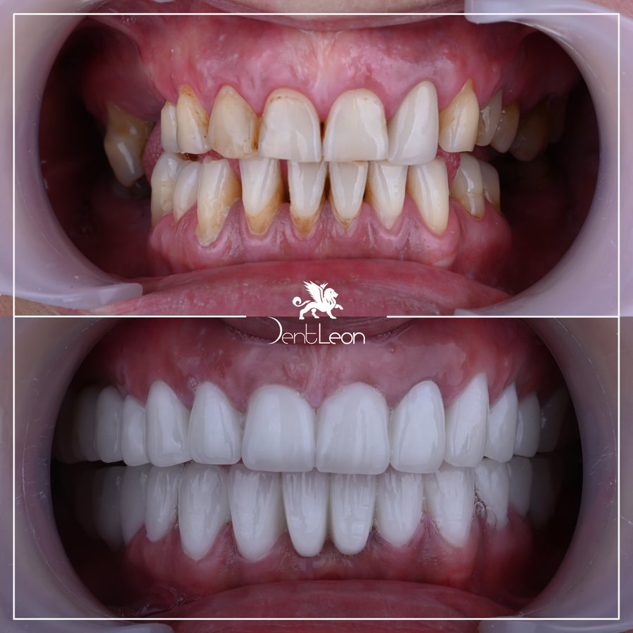 Dent Leon - Dent Leon