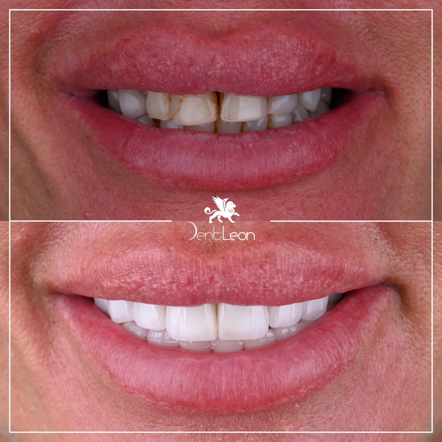 Dent Leon - Dent Leon