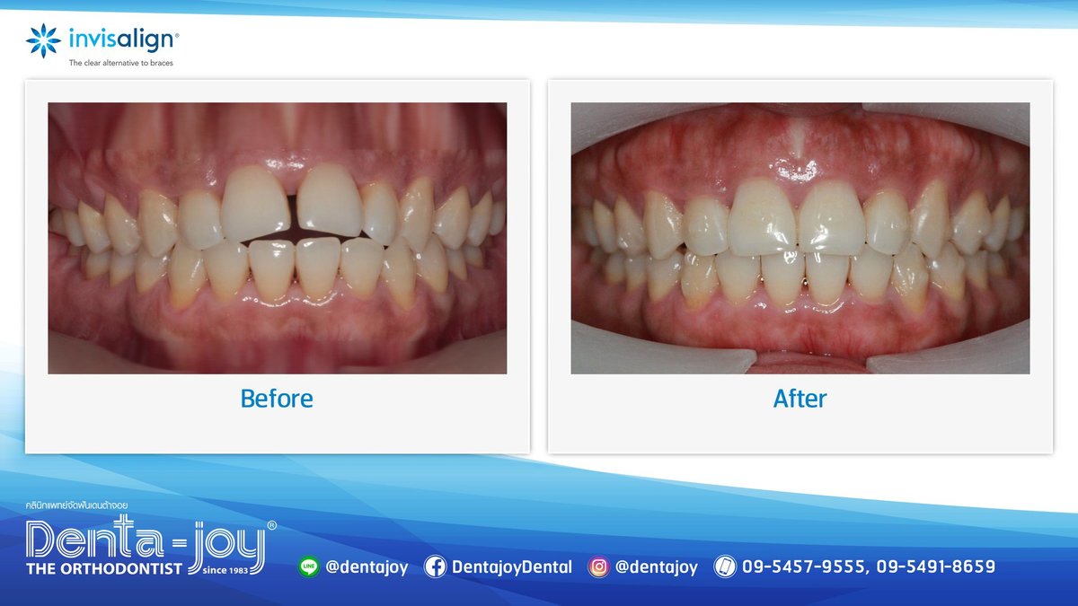 Denta-Joy Invisalign Dedicated Clinic - Denta-Joy Invisalign Dedicated Clinic