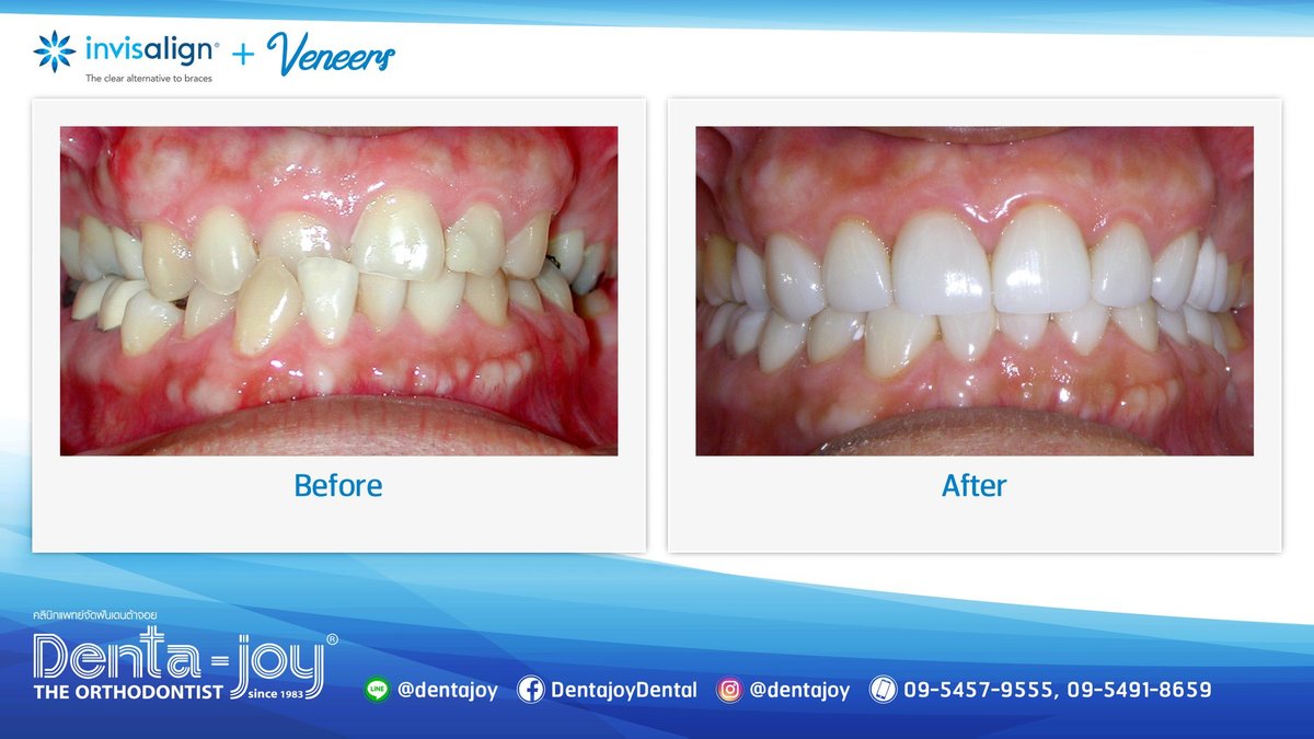 Denta-Joy Invisalign Dedicated Clinic - Denta-Joy Invisalign Dedicated Clinic