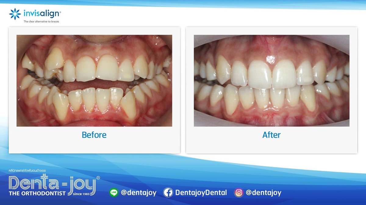 Denta-Joy Invisalign Dedicated Clinic - Denta-Joy Invisalign Dedicated Clinic
