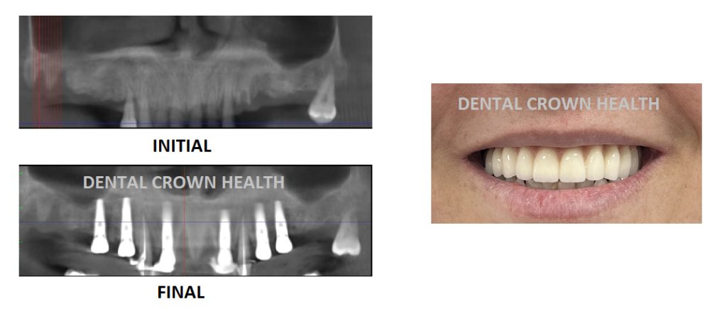 Dental Crown Health - Dental Crown Health