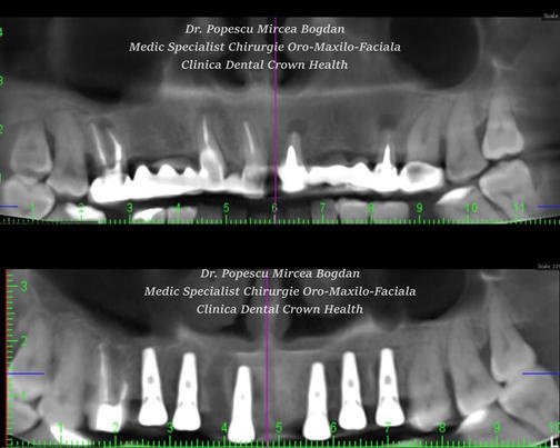 Dental Crown Health - Dental Crown Health