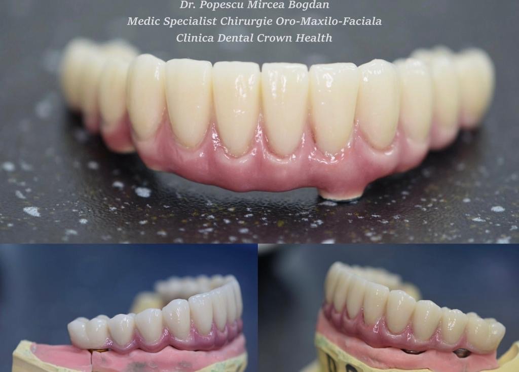 Dental Crown Health - Dental Crown Health