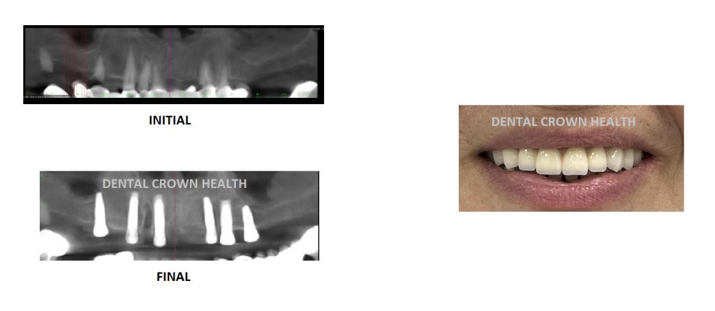 Dental Crown Health - Dental Crown Health