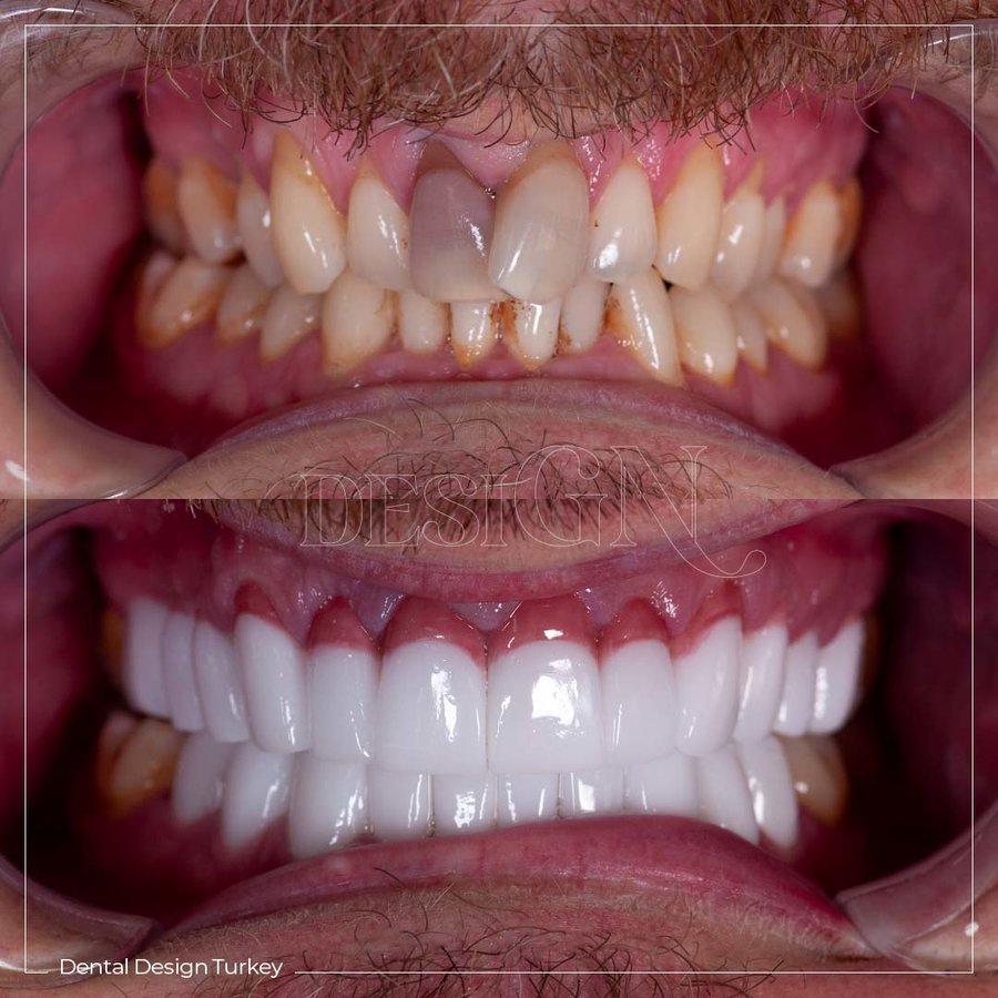 Dental Design Turkey - Dental Design Turkey