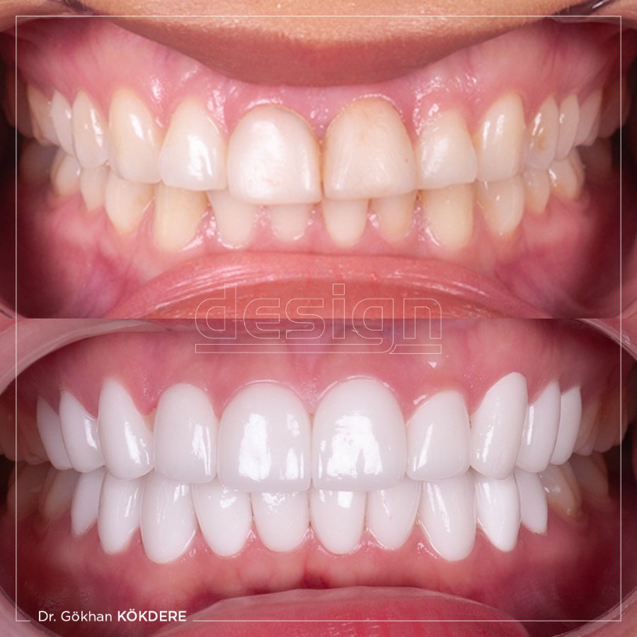 Dental Design Turkey - Dental Design Turkey