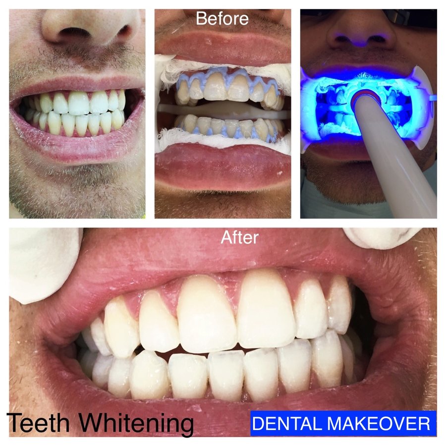 DENTAL MAKEOVER - DENTAL MAKEOVER