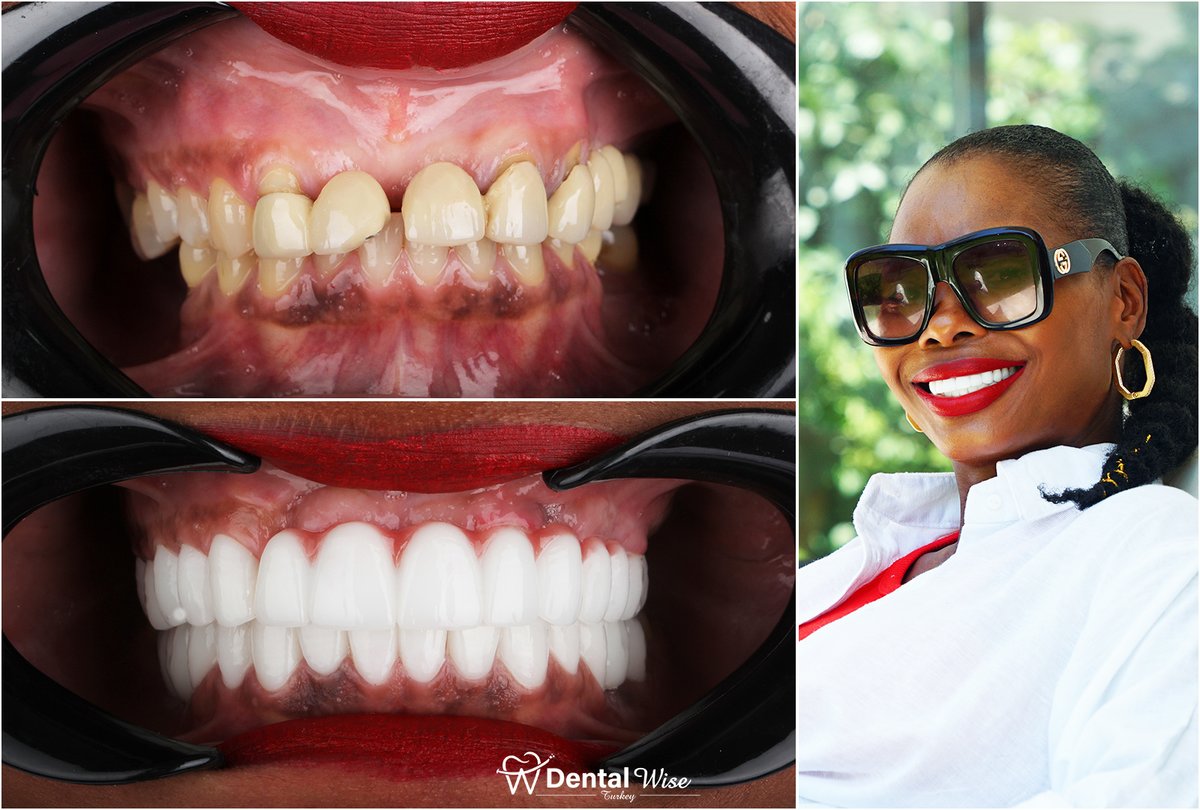 Dental Wise Turkey - Dental Wise Turkey