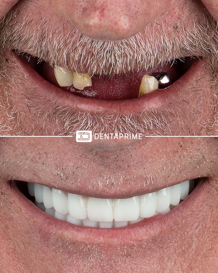 Dentaprime F3T - Dentaprime F3T