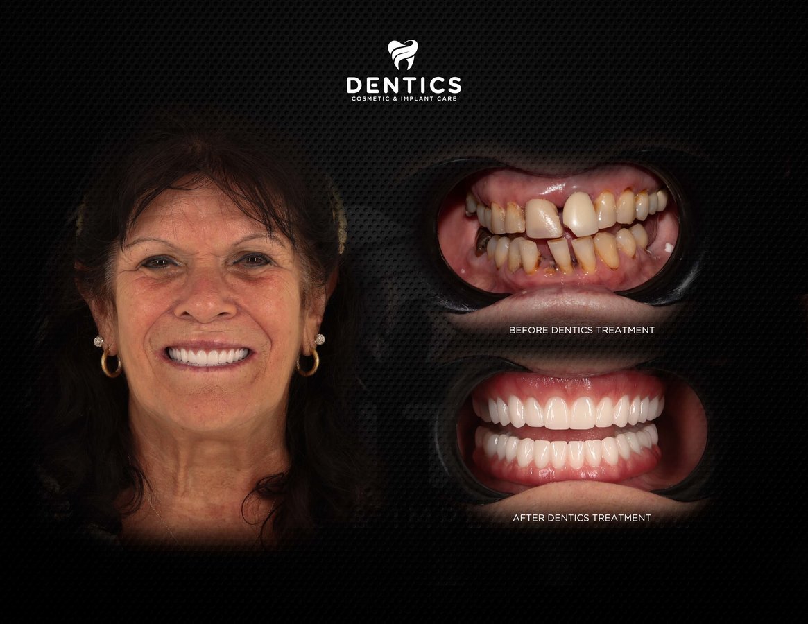 Dentics Cancun - Dentics Cancun