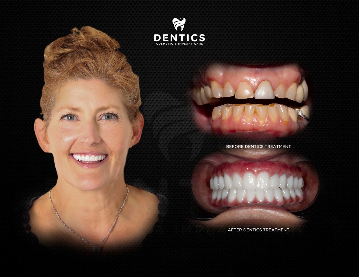 Dentics Cancun - Dentics Cancun