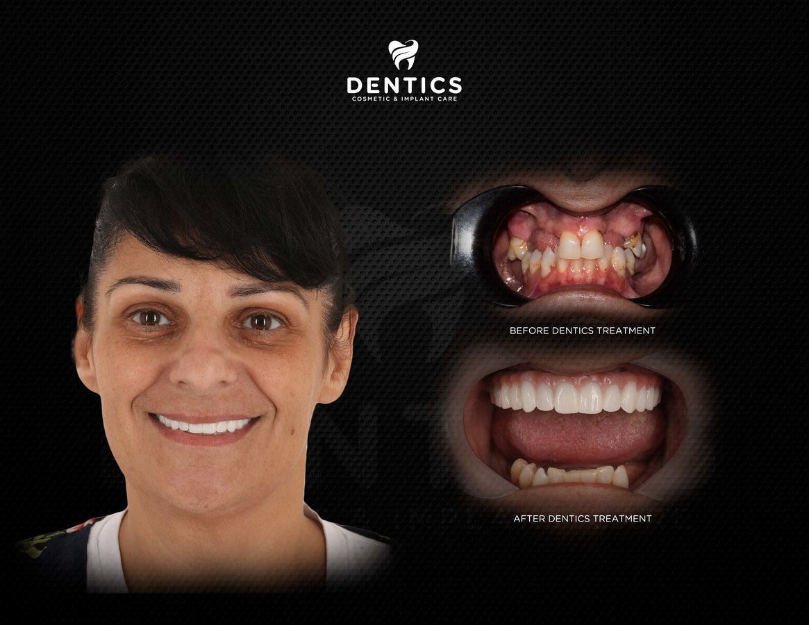 Dentics Cancun - Dentics Cancun