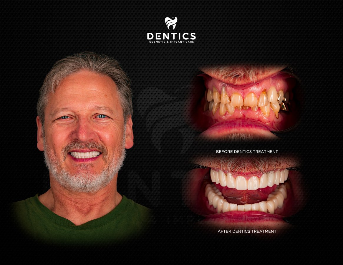Dentics Cancun - Dentics Cancun
