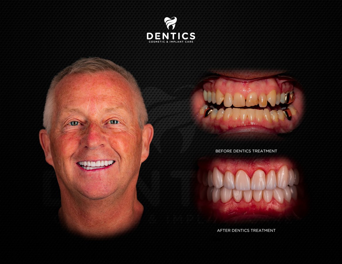 Dentics Cancun - Dentics Cancun