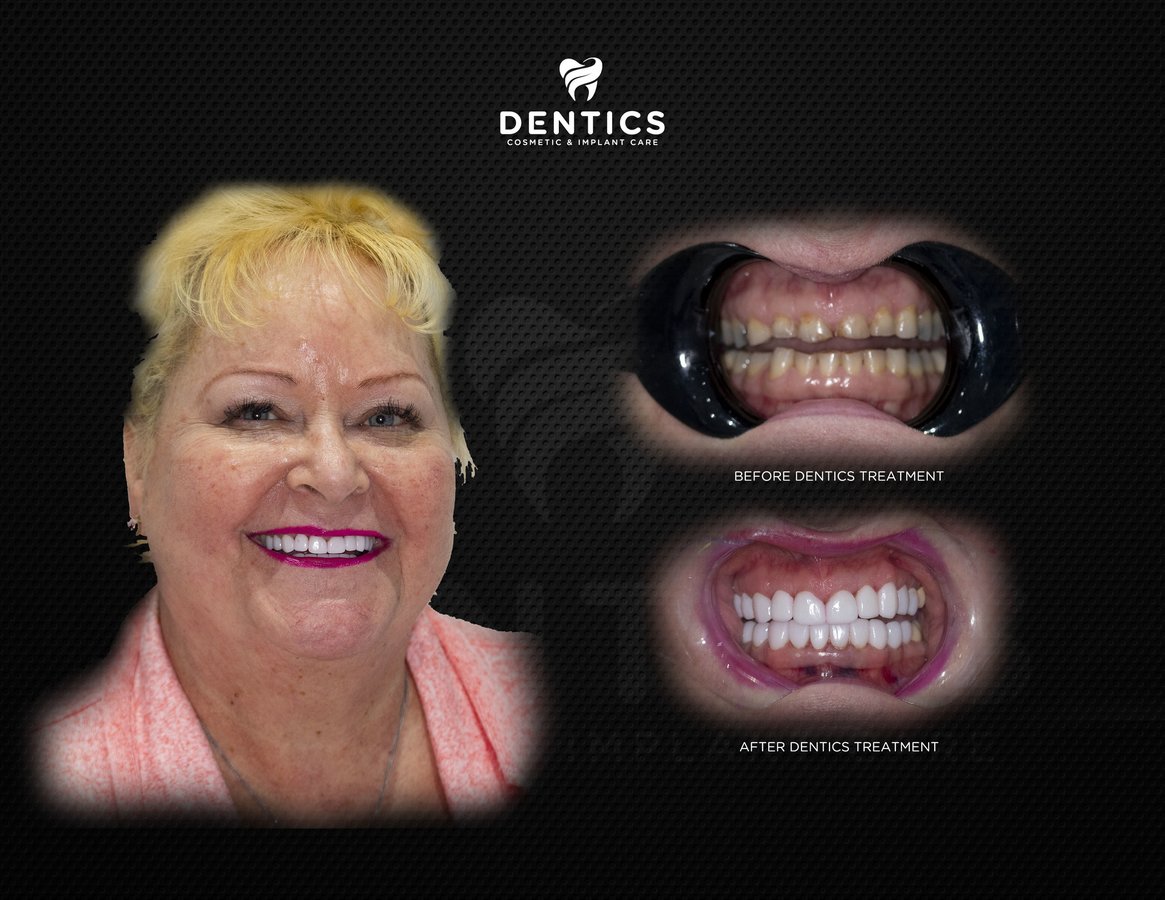 Dentics Cancun - Dentics Cancun