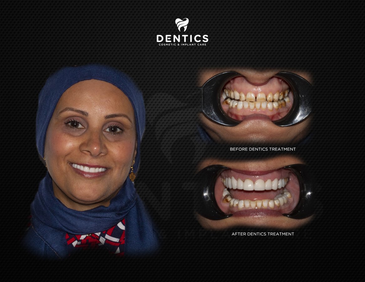 Dentics Cancun - Dentics Cancun