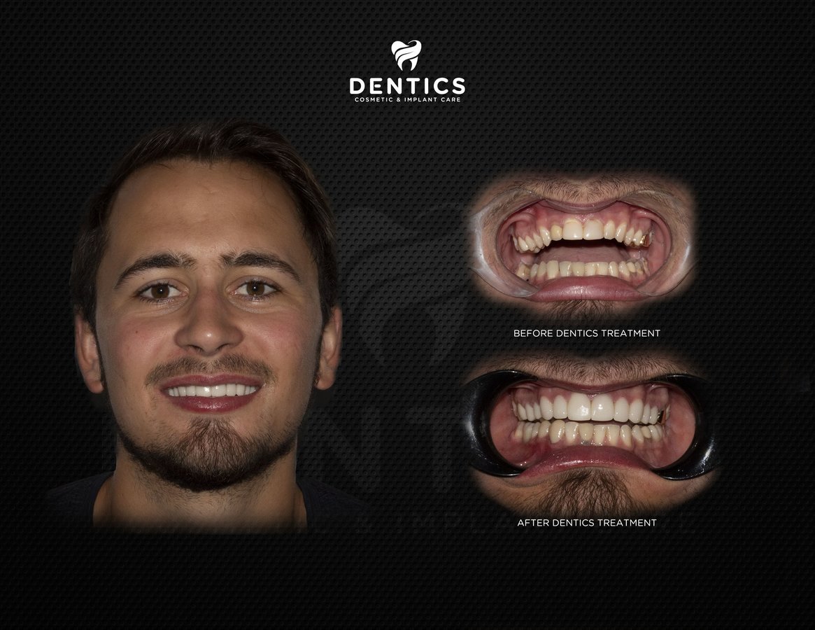 Dentics Cancun - Dentics Cancun