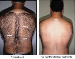 Derma Sculpt Clinic - Bellandur Outer Ring Road - Derma Sculpt Clinic - Bellandur Outer Ring Road
