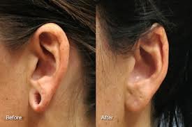 Derma Sculpt Clinic - Bellandur Outer Ring Road - Derma Sculpt Clinic - Bellandur Outer Ring Road