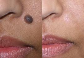 Derma Sculpt Clinic - Bellandur Outer Ring Road - Derma Sculpt Clinic - Bellandur Outer Ring Road