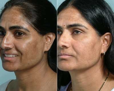 Derma Sculpt Clinic - Bellandur Outer Ring Road - Derma Sculpt Clinic - Bellandur Outer Ring Road