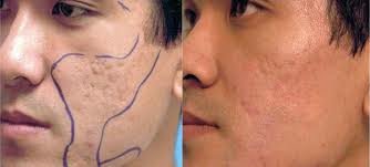 Derma Sculpt Clinic - Bellandur Outer Ring Road - Derma Sculpt Clinic - Bellandur Outer Ring Road