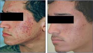 Derma Sculpt Clinic - Bellandur Outer Ring Road - Derma Sculpt Clinic - Bellandur Outer Ring Road