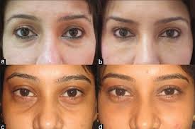 Derma Sculpt Clinic - Bellandur Outer Ring Road - Derma Sculpt Clinic - Bellandur Outer Ring Road