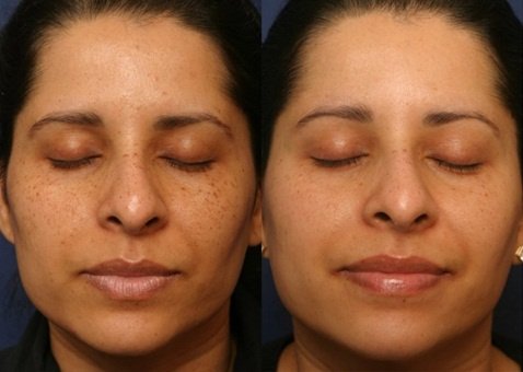 Derma Sculpt Clinic - Bellandur Outer Ring Road - Derma Sculpt Clinic - Bellandur Outer Ring Road