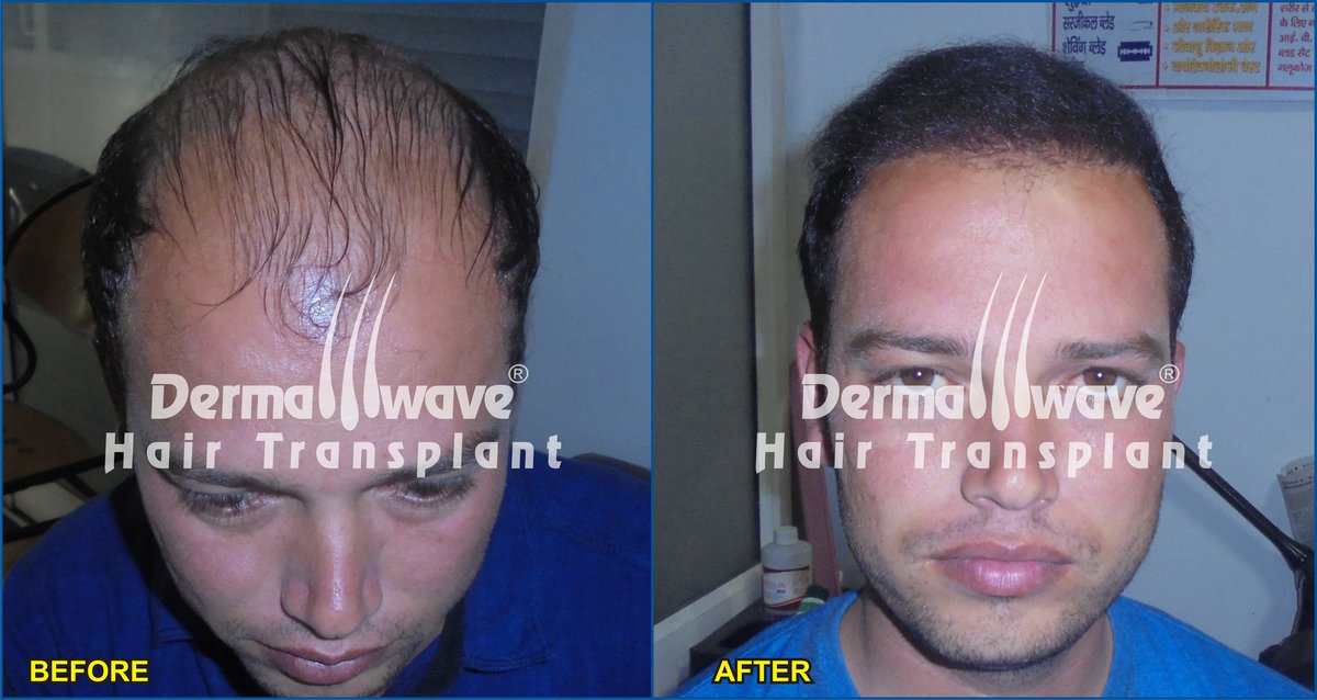 Dermawave Hair Transplant and Dermacare Skin & Laser Cdentre - Dermawave Hair Transplant and Dermacare Skin & Laser Cdentre