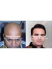 Dermawave Hair Transplant and Dermacare Skin & Laser Cdentre - Dermawave Hair Transplant and Dermacare Skin & Laser Cdentre
