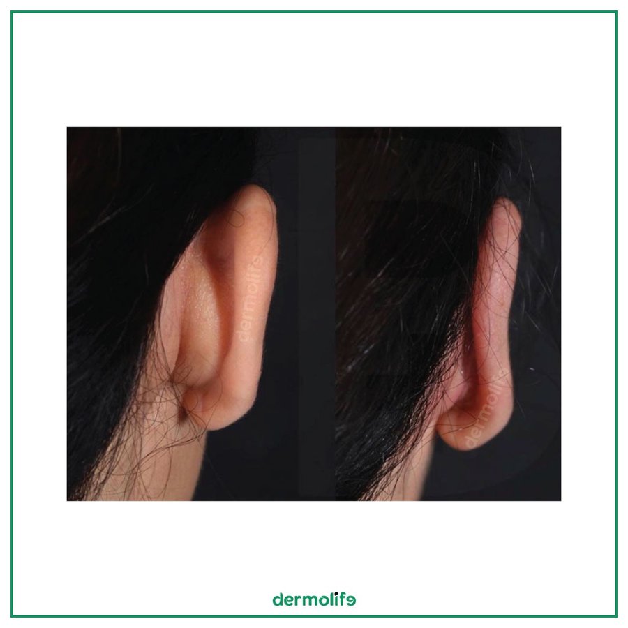 Dermolife - Dermolife