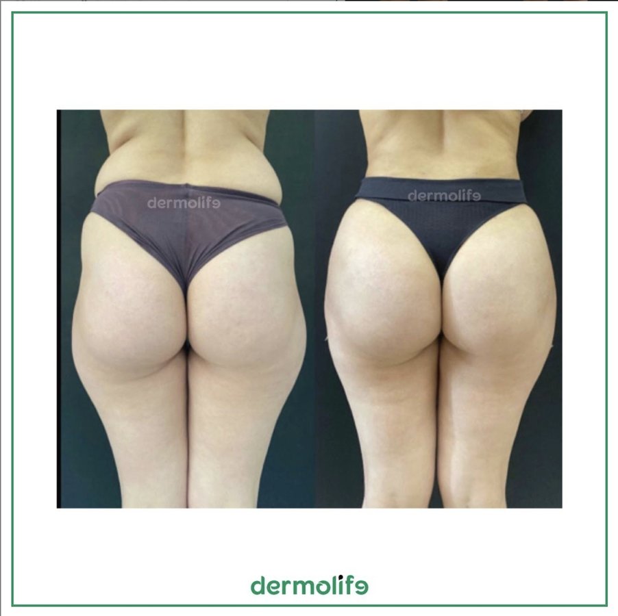 Dermolife - Dermolife