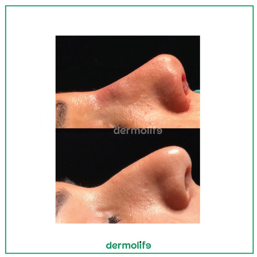 Dermolife - Dermolife