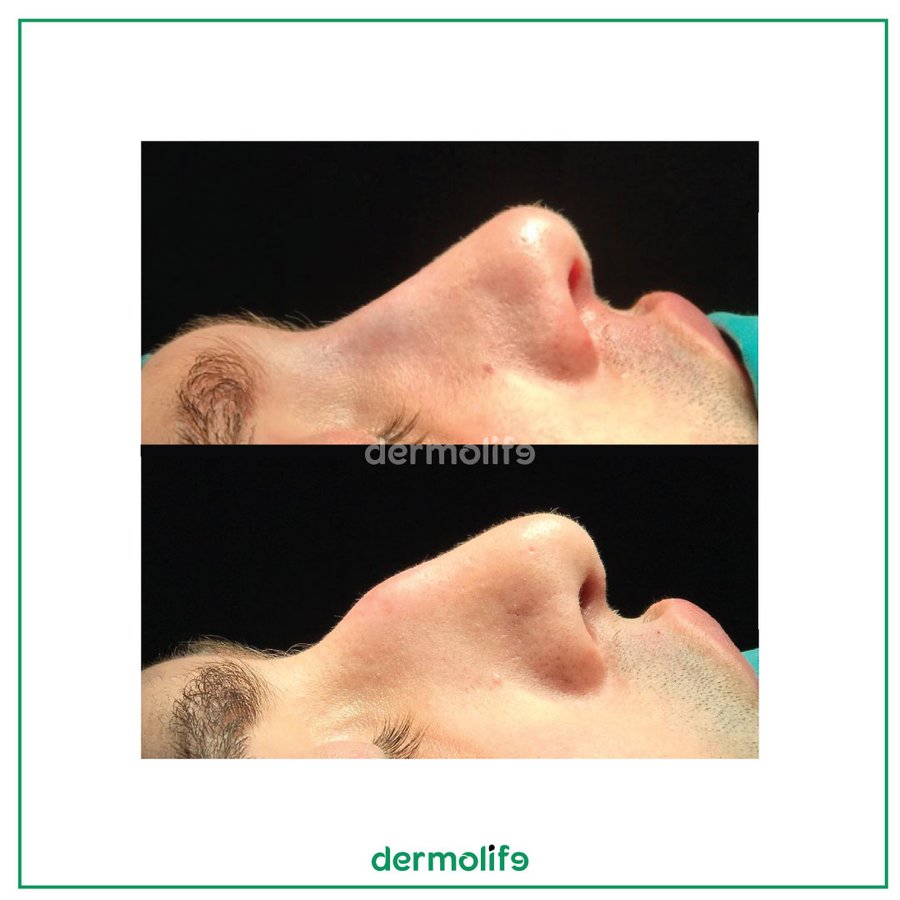 Dermolife - Dermolife