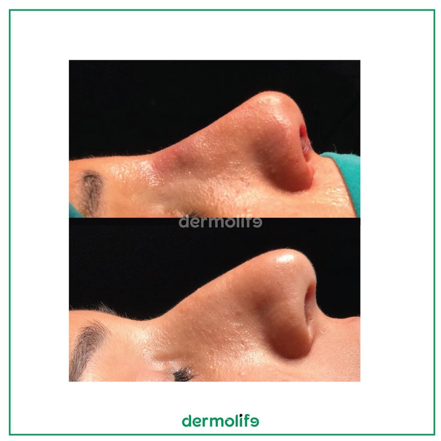 Dermolife - Dermolife