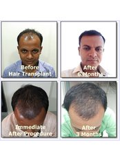 Dev Hair Transplant Clinic - Dev Hair Transplant Clinic