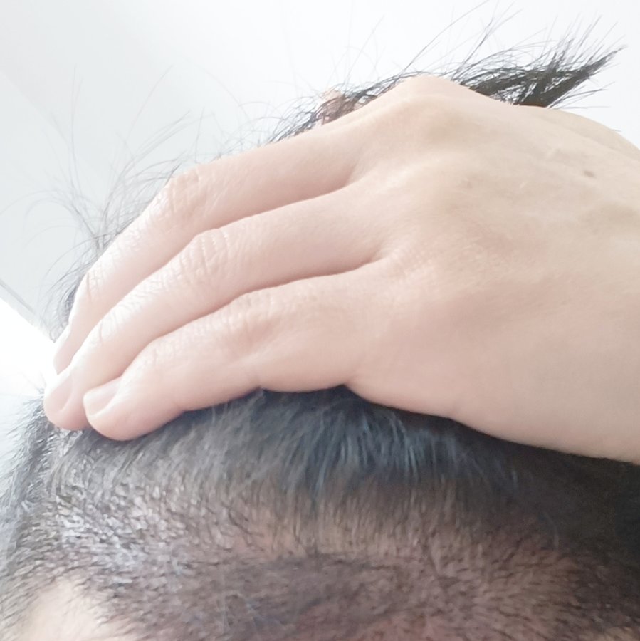 DHI-Direct Hair Implantation - DHI-Direct Hair Implantation