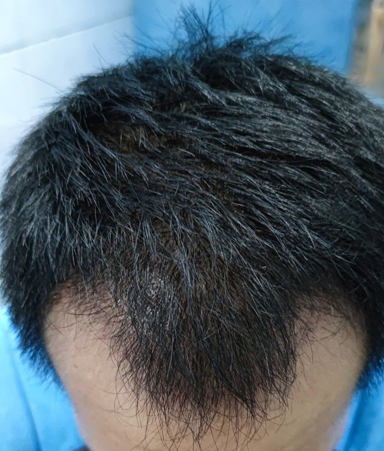 DHI-Direct Hair Implantation - DHI-Direct Hair Implantation