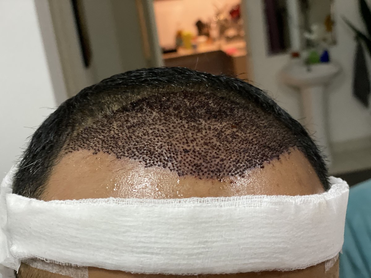 DHI-Direct Hair Implantation - DHI-Direct Hair Implantation